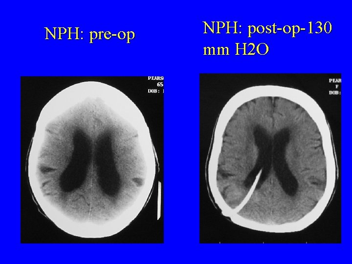 NPH: pre-op NPH: post-op-130 mm H 2 O 