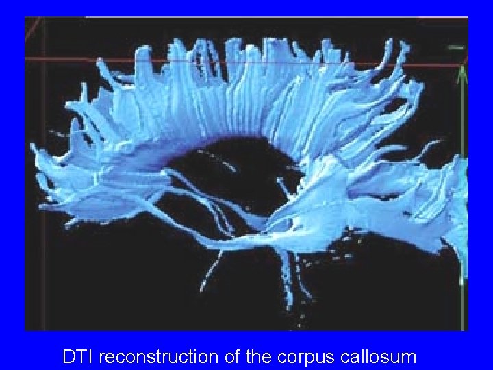 DTI reconstruction of the corpus callosum 