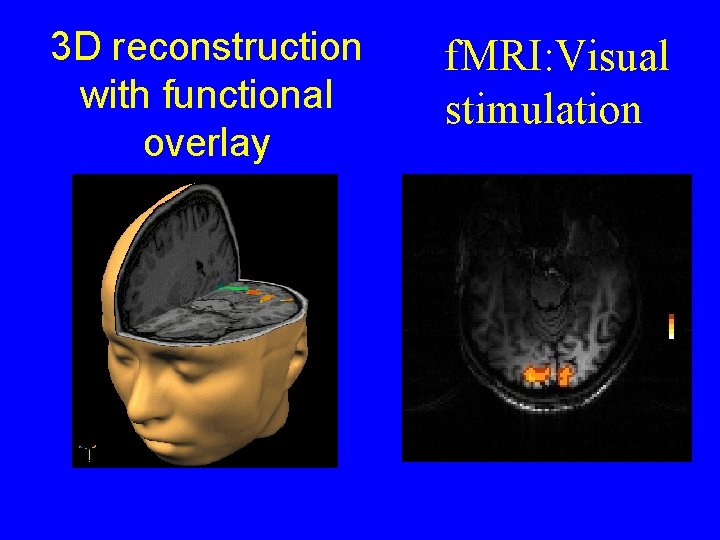 3 D reconstruction with functional overlay f. MRI: Visual stimulation 