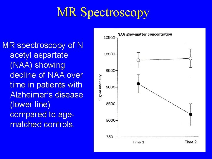MR Spectroscopy MR spectroscopy of N acetyl aspartate (NAA) showing decline of NAA over