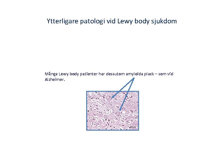 Ytterligare patologi vid Lewy body sjukdom Många Lewy body patienter har dessutom amyloida plack