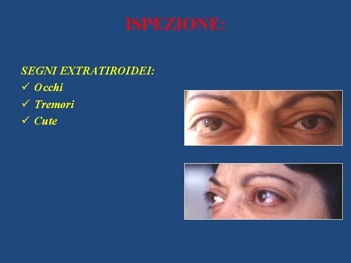 ISPEZIONE: SEGNI EXTRATIROIDEI: ü Occhi ü Tremori ü Cute 