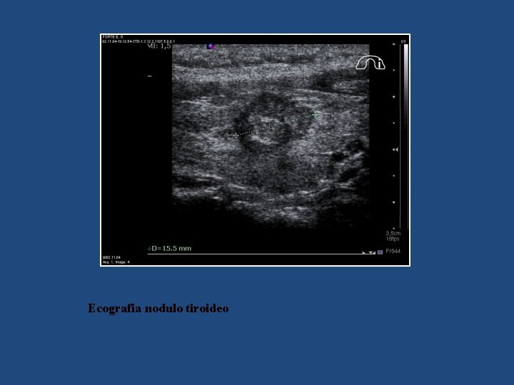 Ecografia nodulo tiroideo 