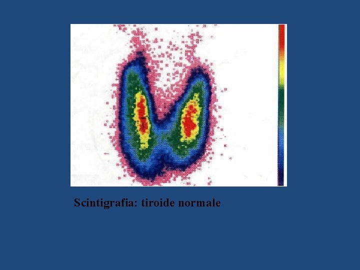 Scintigrafia: tiroide normale 