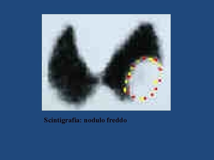 Scintigrafia: nodulo freddo 
