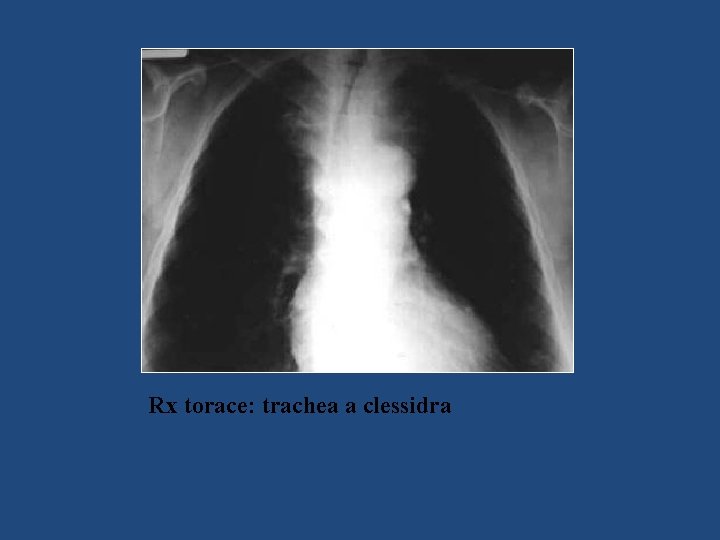 Rx torace: trachea a clessidra 