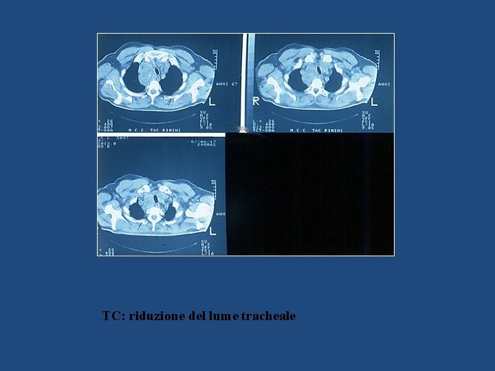 TC: riduzione del lume tracheale 