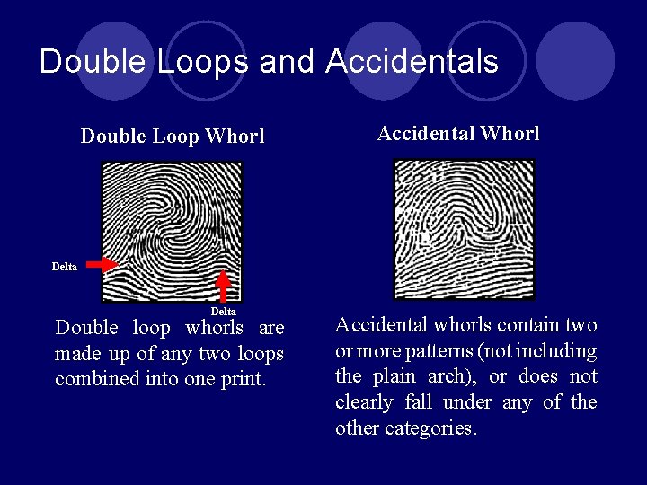 Double Loops and Accidentals Double Loop Whorl Accidental Whorl Delta Double loop whorls are