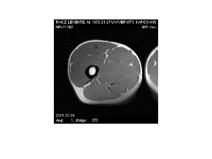 Mágneses rezonancia (MRI) 