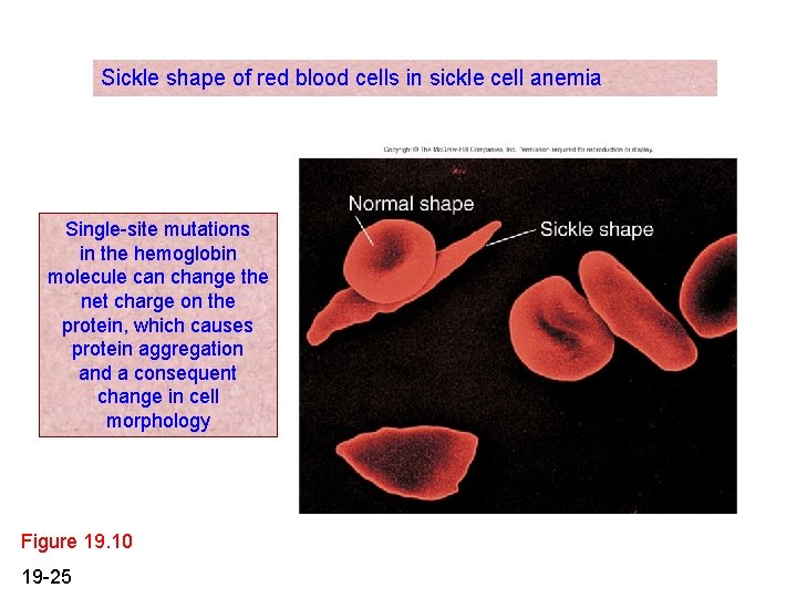 Sickle shape of red blood cells in sickle cell anemia Single-site mutations in the Sickle shape of red blood cells in sickle cell anemia Single-site mutations in the