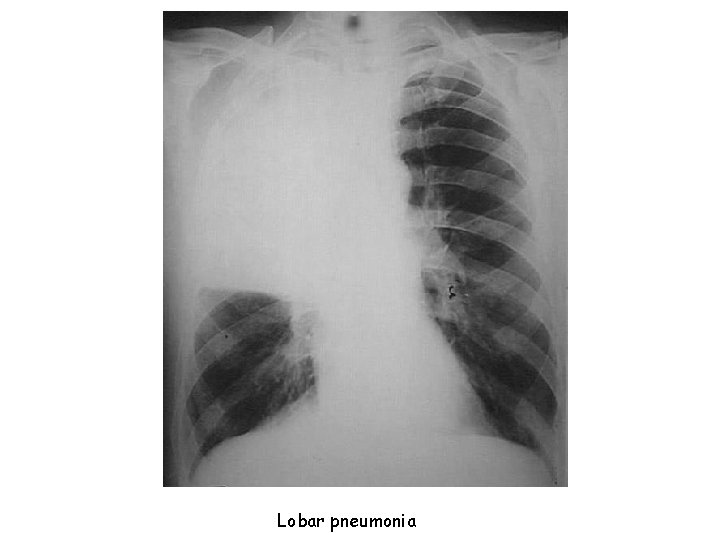 Lobar pneumonia 