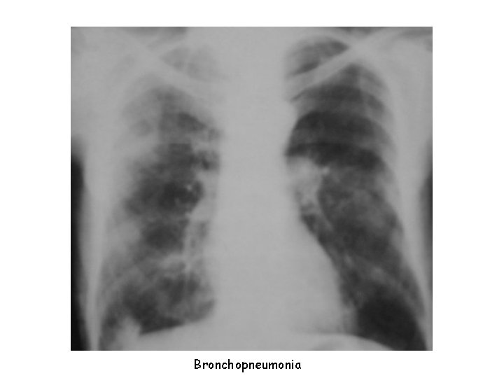 Bronchopneumonia 