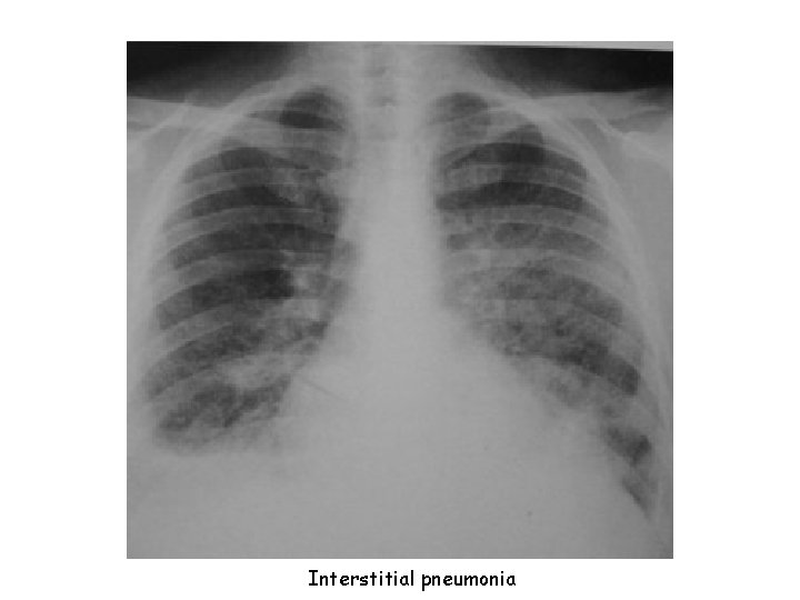 Interstitial pneumonia 