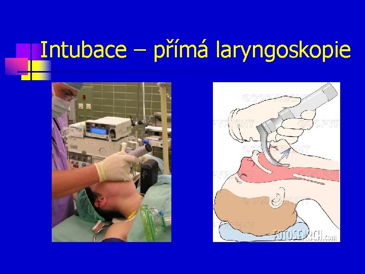 Intubace – přímá laryngoskopie 