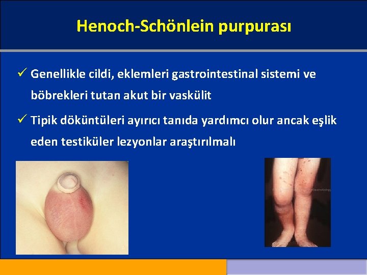 Henoch-Schönlein purpurası ü Genellikle cildi, eklemleri gastrointestinal sistemi ve böbrekleri tutan akut bir vaskülit