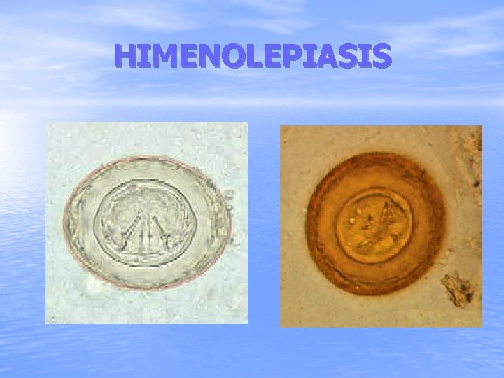 HIMENOLEPIASIS 