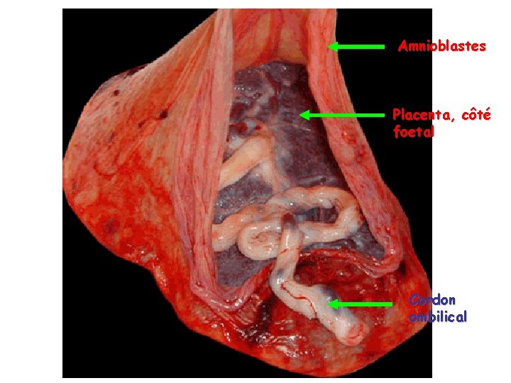 Amnioblastes Placenta, côté foetal Cordon ombilical 