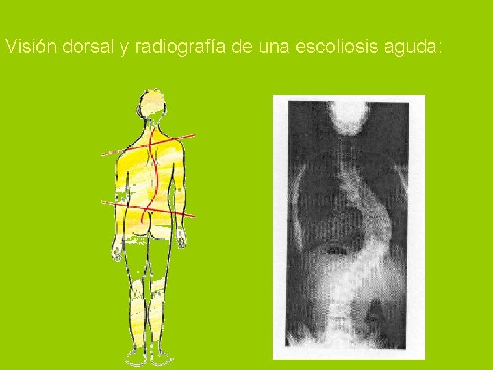 Visión dorsal y radiografía de una escoliosis aguda: 