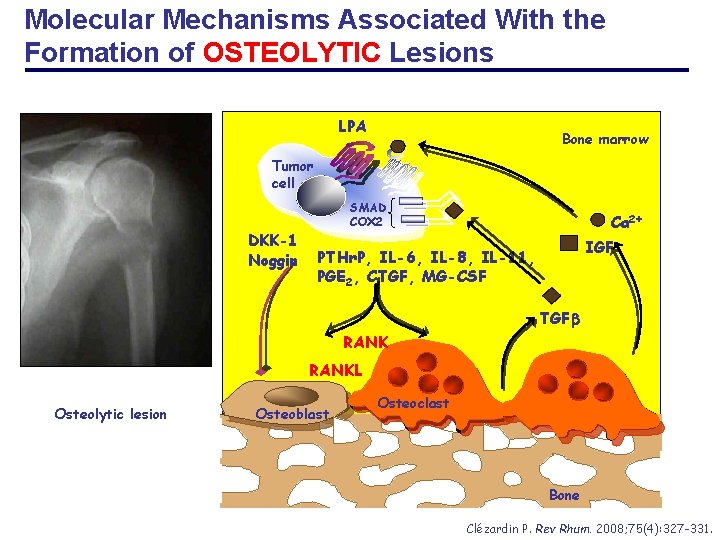 Molecular Mechanisms Associated With the Formation of OSTEOLYTIC Lesions LPA Bone marrow Tumor cell
