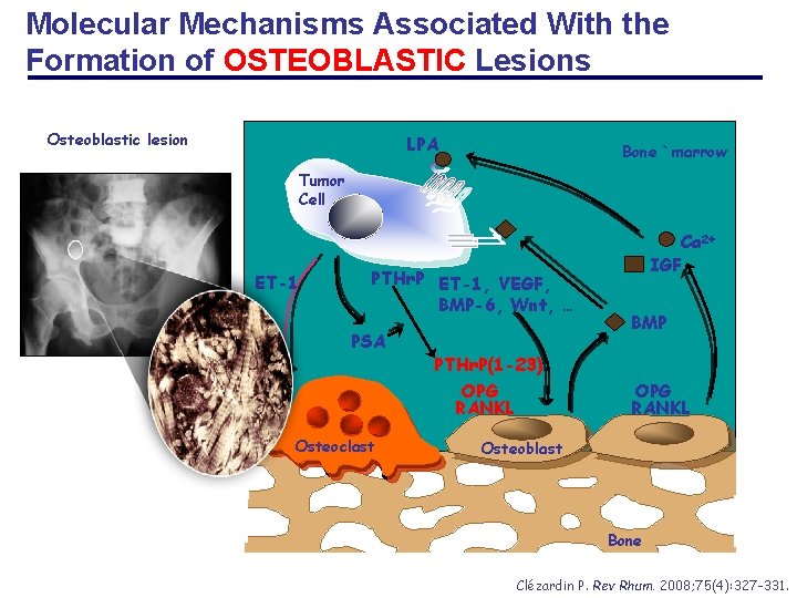 Molecular Mechanisms Associated With the Formation of OSTEOBLASTIC Lesions Osteoblastic lesion LPA Bone `marrow