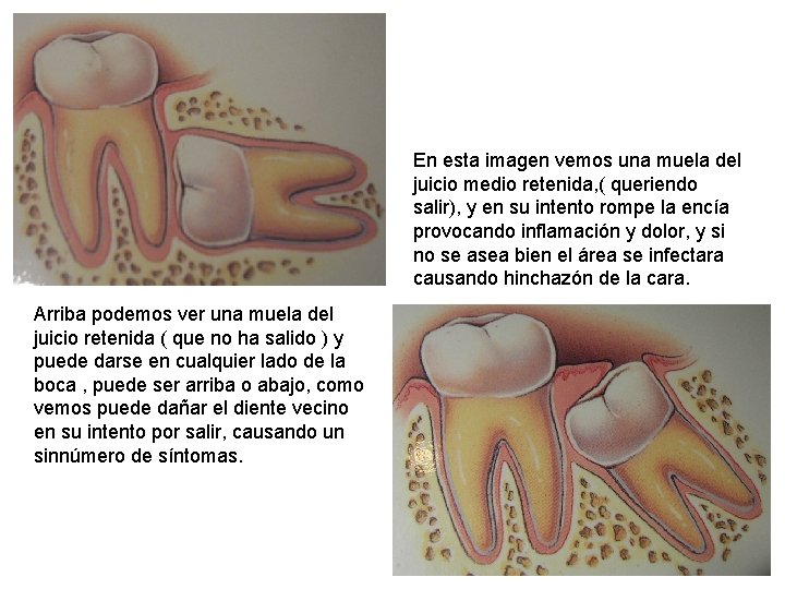 En esta imagen vemos una muela del juicio medio retenida, ( queriendo salir), y