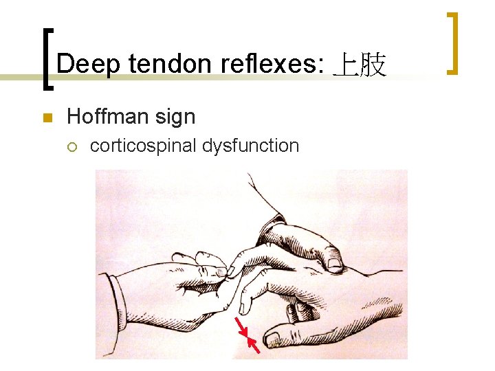 Deep tendon reflexes: 上肢 n Hoffman sign ¡ corticospinal dysfunction 