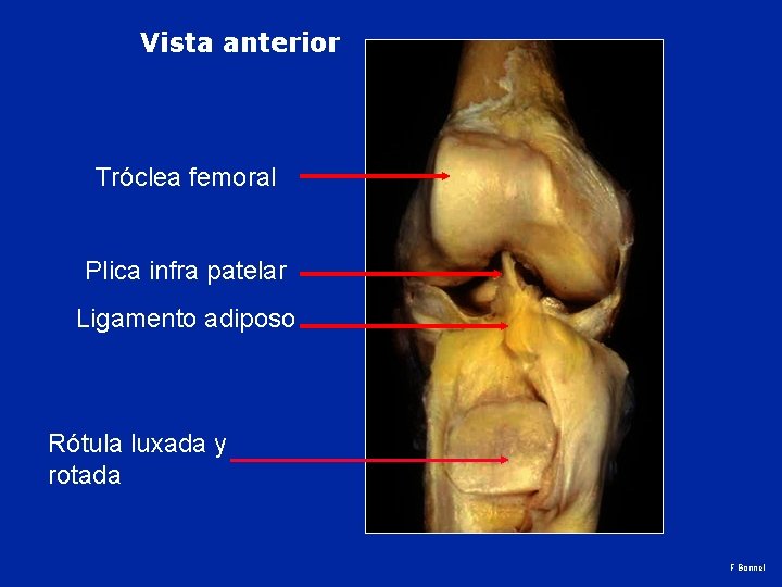 Vista anterior Tróclea femoral Plica infra patelar Ligamento adiposo Rótula luxada y rotada F