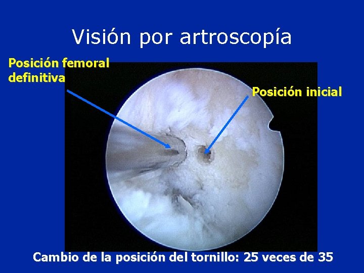 Visión por artroscopía Posición femoral definitiva Posición inicial Cambio de la posición del tornillo: