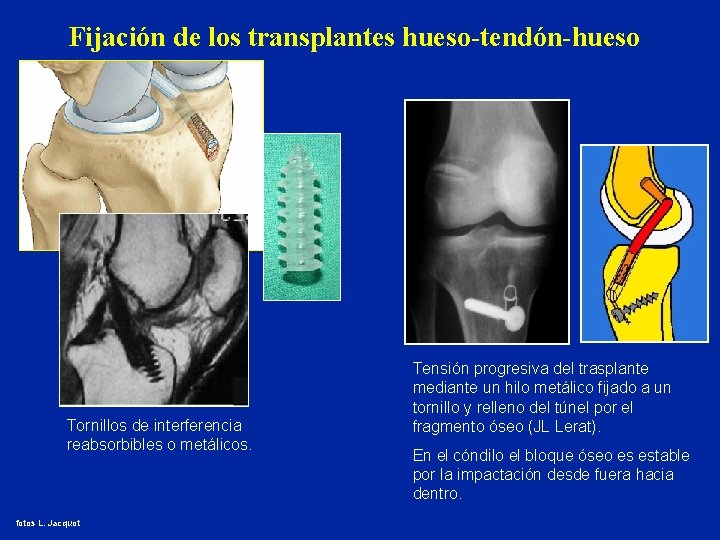 Fijación de los transplantes hueso-tendón-hueso Tornillos de interferencia reabsorbibles o metálicos. fotos L. Jacquot