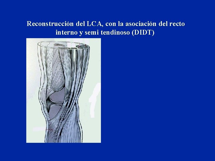 Reconstrucción del LCA, con la asociación del recto interno y semi tendinoso (DIDT) 
