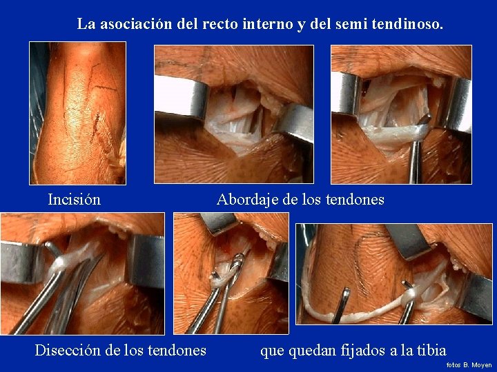 La asociación del recto interno y del semi tendinoso. Incisión Abordaje de los tendones