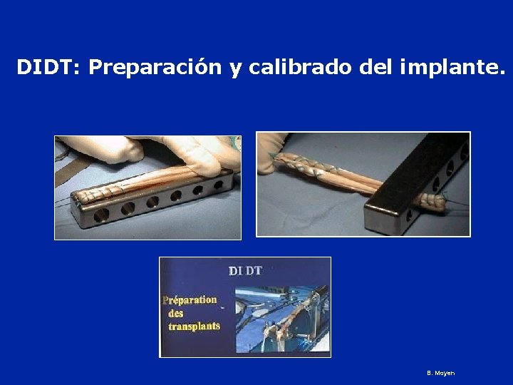 DIDT: Preparación y calibrado del implante. B. Moyen 