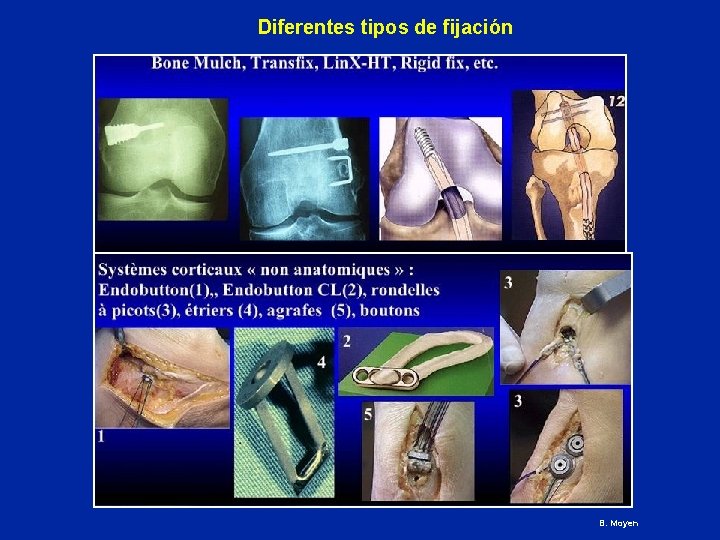 Diferentes tipos de fijación B. Moyen 