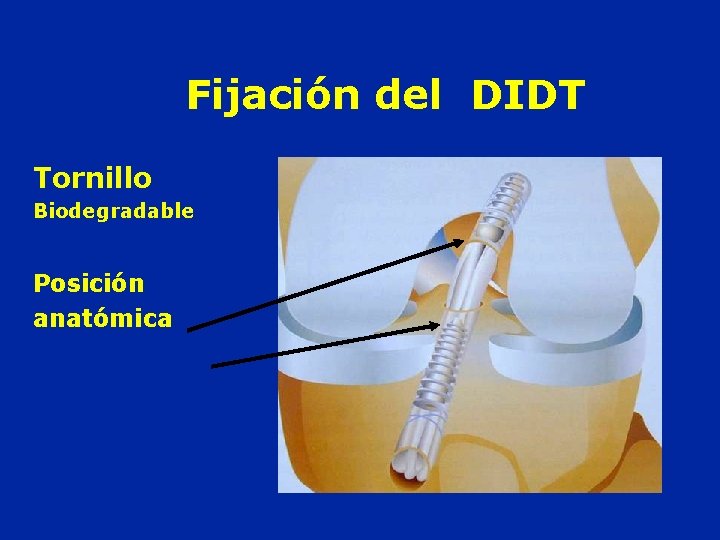 Fijación del DIDT Tornillo Biodegradable Posición anatómica 