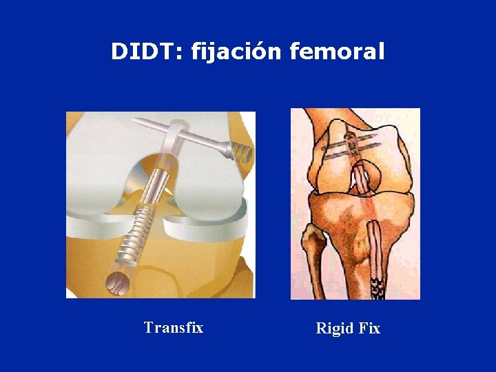 DIDT: fijación femoral Transfix Rigid Fix 