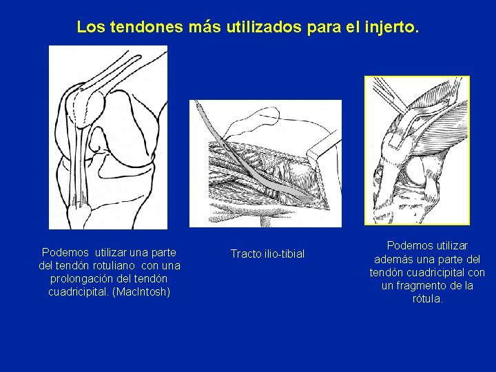 Los tendones más utilizados para el injerto. Podemos utilizar una parte del tendón rotuliano