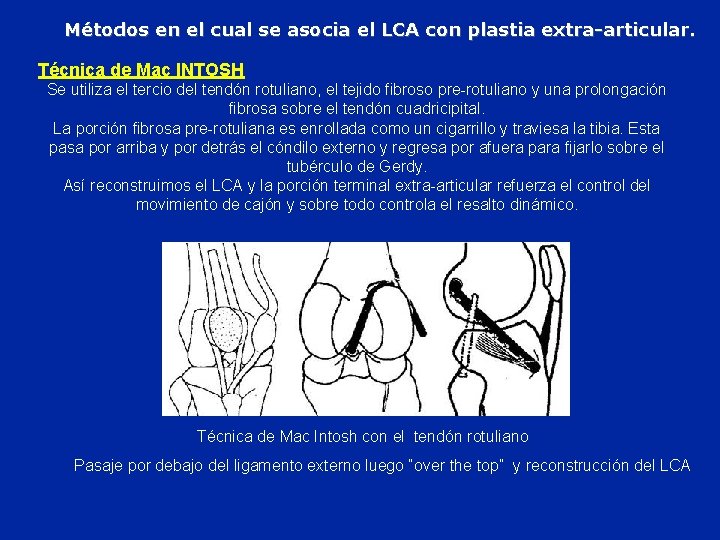 Métodos en el cual se asocia el LCA con plastia extra-articular. Técnica de Mac