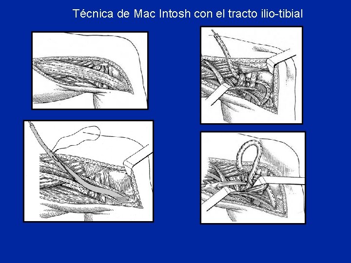 Técnica de Mac Intosh con el tracto ilio-tibial 