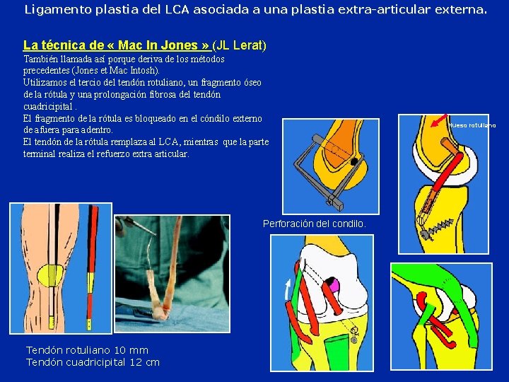 Ligamento plastia del LCA asociada a una plastia extra-articular externa. La técnica de «