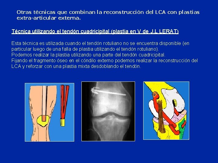 Otras técnicas que combinan la reconstrucción del LCA con plastias extra-articular externa. Técnica utilizando