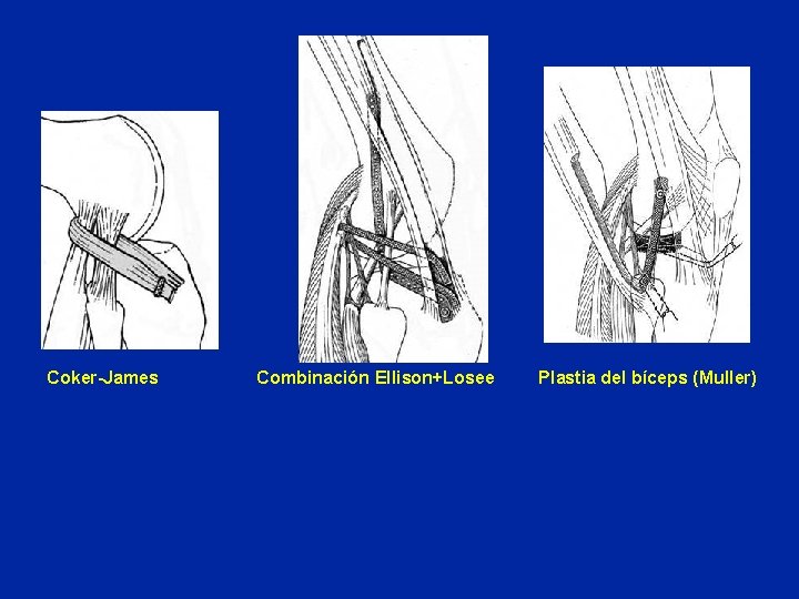  Coker-James Combinación Ellison+Losee Plastia del bíceps (Muller) 