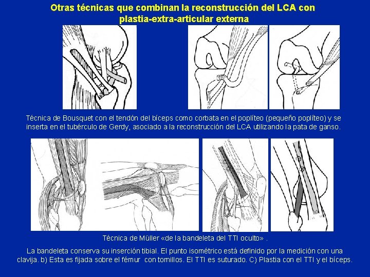 Otras técnicas que combinan la reconstrucción del LCA con plastia-extra-articular externa Técnica de Bousquet