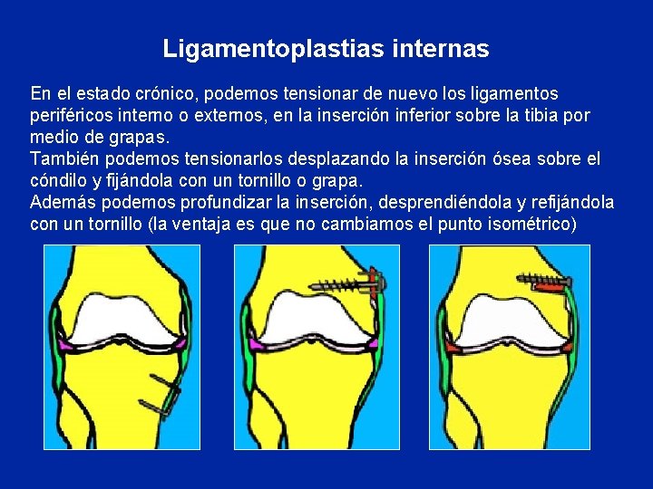 Ligamentoplastias internas En el estado crónico, podemos tensionar de nuevo los ligamentos periféricos interno