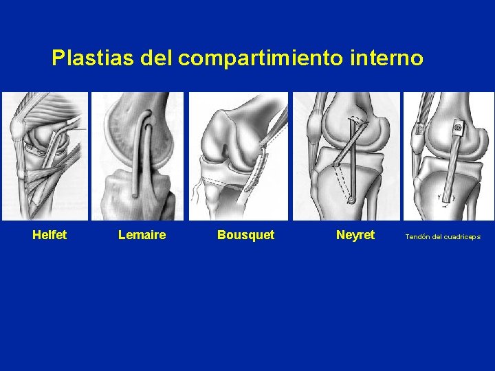 Plastias del compartimiento interno Helfet Lemaire Bousquet Neyret Tendón del cuadriceps 