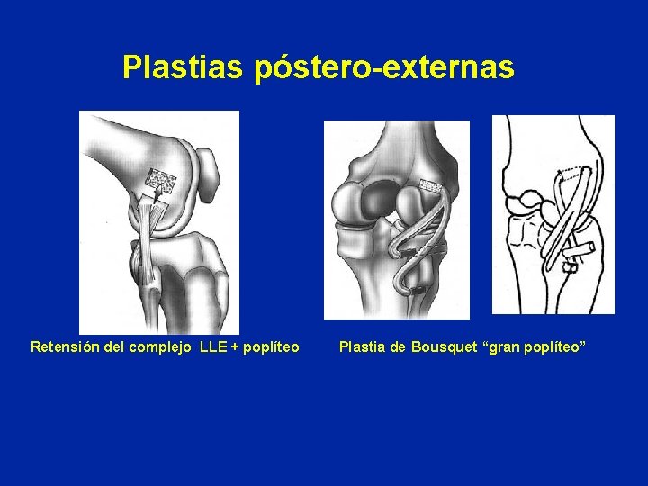 Plastias póstero-externas Retensión del complejo LLE + poplíteo Plastia de Bousquet “gran poplíteo” 