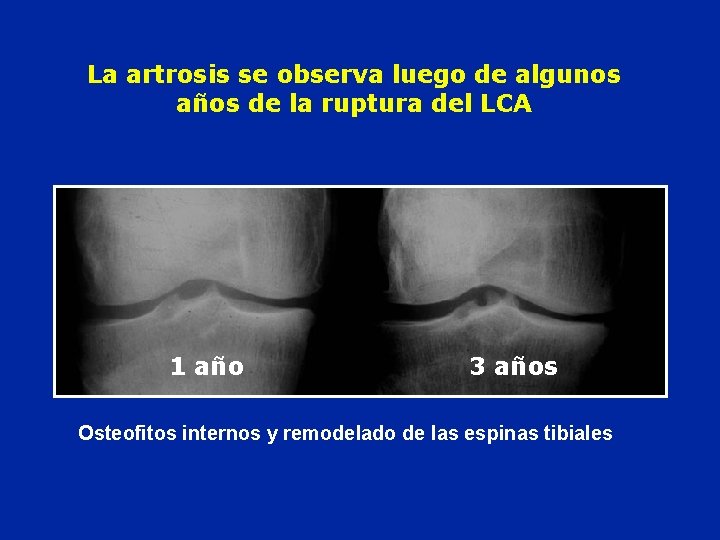 La artrosis se observa luego de algunos años de la ruptura del LCA 1