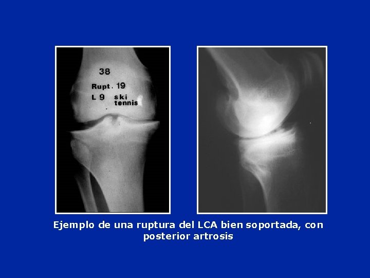 Ejemplo de una ruptura del LCA bien soportada, con posterior artrosis 