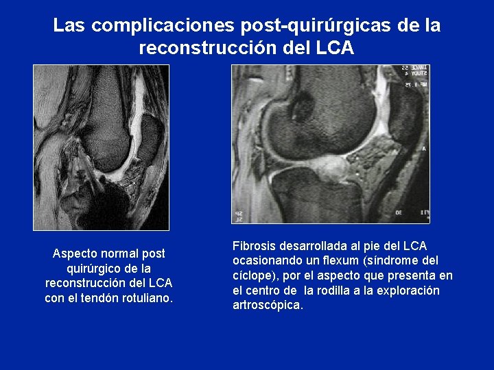 Las complicaciones post-quirúrgicas de la reconstrucción del LCA Aspecto normal post quirúrgico de la