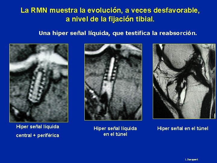 La RMN muestra la evolución, a veces desfavorable, a nivel de la fijación tibial.