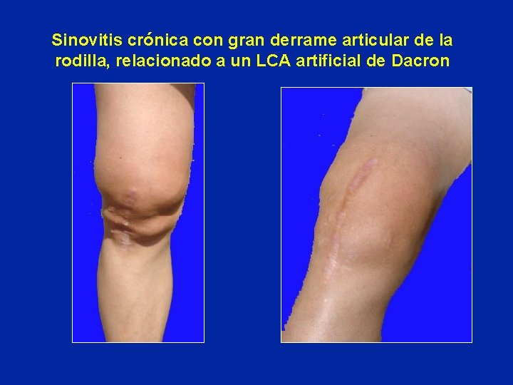 Sinovitis crónica con gran derrame articular de la rodilla, relacionado a un LCA artificial